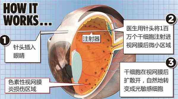 向眼球注射干细胞治失明
